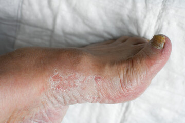 Skin damage, a wound on a woman's legs. Diseases of the skin. Damage to the nail plate, nail by a fungal disease