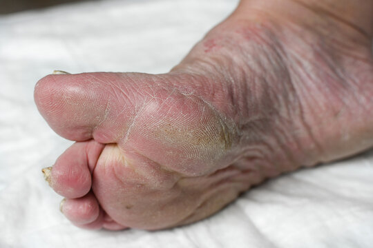 Skin damage, a wound on a woman's legs. Diseases of the skin. Damage to the nail plate, nail by a fungal disease