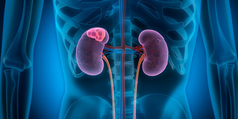 Medically 3D illustration showing a tumor in right kidney, x-ray style