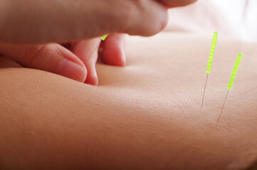 鍼灸院で背中に鍼治療をする女性