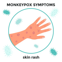 Monkeypox virus Symptoms. Human hand with skin rash. Pandemic, monkeypox epidemic. Medical poster, banner