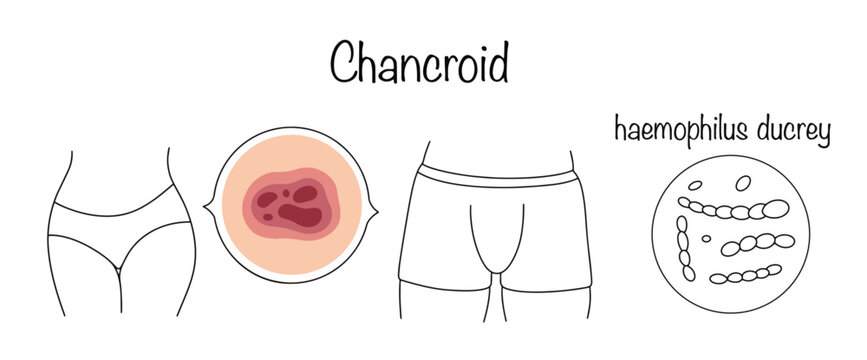 Chancroid