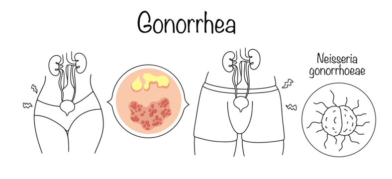 Gonorrhea