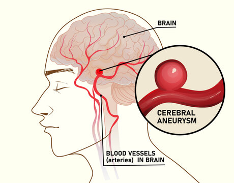 A brain (cerebral) aneurysm. Healthcare illustration. Educational medical illustration. Vector illustration. 