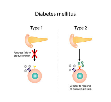 「Type 2 Diabetes」の写真素材 6,141件の無料イラスト画像 Adobe Stock