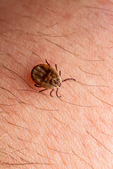 Infectious Encephalitis Tick on Skin. Encephalitis Virus or Lyme Borreliosis Disease Infected Dermacentor Tick Arachnid Parasite Bite Close-up.