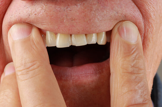 
Man demonstrating his two front Incisors teeth that are chipped
