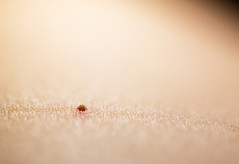 Obraz premium Close-Up of a Tick Embedded in Human Skin: Highlights Risks of Lyme Disease and Other Tick-Borne Illnesses