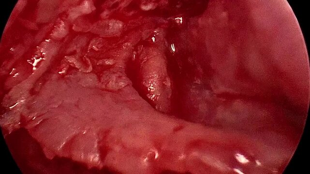 Medical Procedure: Tympanoplasty for Eardrum Reconstruction