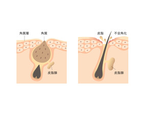 図版_肌図版_007_毛穴詰まりと皮脂