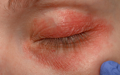 Obraz premium Zapalenie powiek, egzema skóry powiek z bliska 