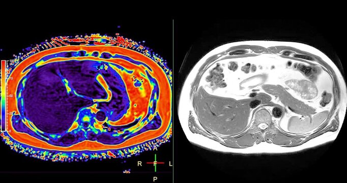 An MRI PET scan of the abdomen in axial view provides a detailed cross-sectional image, helping to detect abnormalities with high precision.