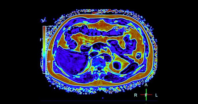 An MRI PET scan of the abdomen in axial view provides a detailed cross-sectional image, helping to detect abnormalities with high precision.