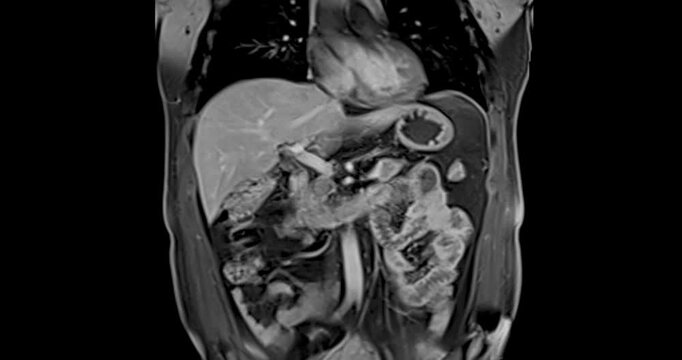 MRI abdomen coronal views are particularly useful for assessing liver, kidneys, and other abdominal organs with precision.