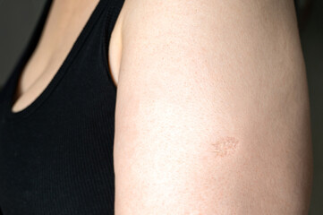 Fototapeta premium BCG or TB vaccine scar marks Monkeypox and smallpox vaccines on a woman's left arm