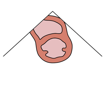 傍胸骨左縁短軸断層像乳頭筋レベル