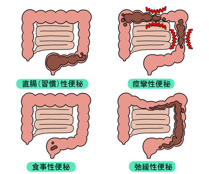 便秘の種類