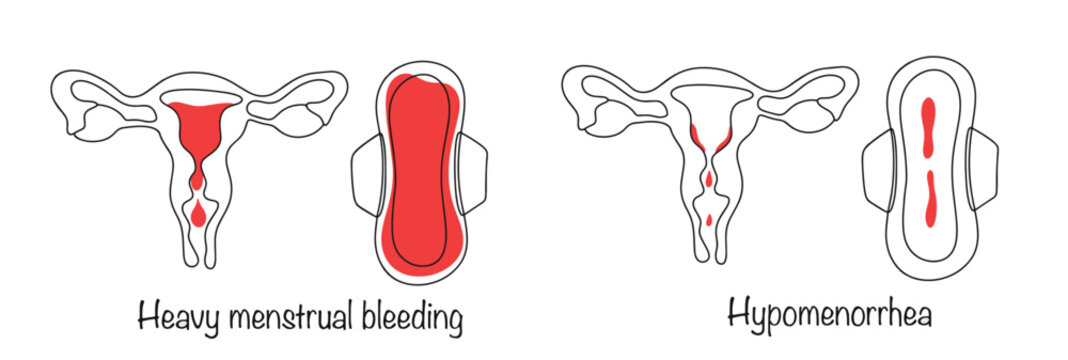 Menorrhagia. Hypomenorrhea