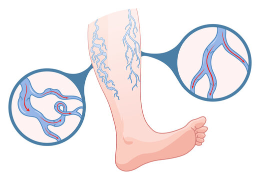 Varicose veins. Blue blood vessel visible through the skin, abnormally swollen leg. Vascular disease diagnostic and treatment. Venous insufficiency medical disease