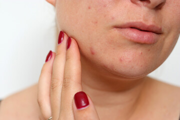 Close up of female face with red problematic acne skin and scars