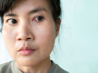 Pterygium cataract eyes inflammation after peel off the pterygium, medical inject drug into lesion...