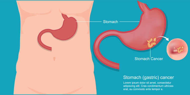 Stomach (gastric) cancer is cancer.