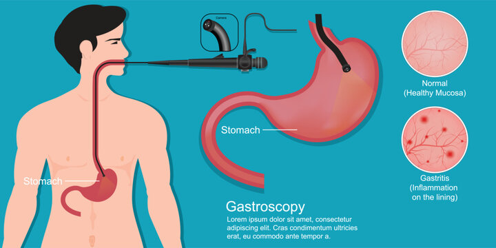 Gastroscopy is a test to check inside your throat.
