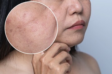 Enlarged circles indicate facial skin problems such as blemishes, freckles, uneven skin tone and...