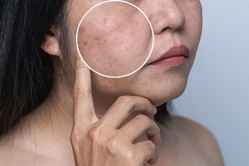 Enlarged circles indicate facial skin problems such as blemishes, freckles, uneven skin tone and...