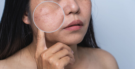 Enlarged circles indicate facial skin problems such as blemishes, freckles, uneven skin tone and...