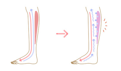 足のむくみ：むくみの発生原因イメージイラスト（断面図）