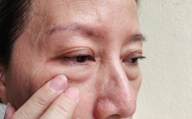 portrait the fingers holding the flabbiness and wrinkle beside the eyelid, swelling and ptosis, dark spots and blemish, freckles and loose, scar and dry skin on the face of the woman.