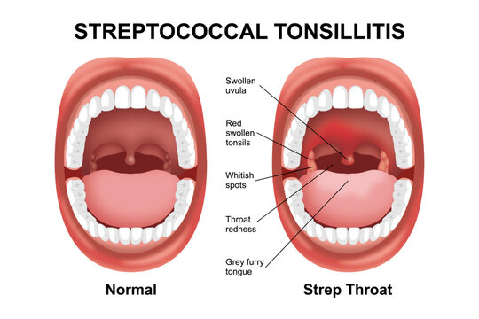 Streptococcal Tonsillitis (Strep throat) bacterial infection in mouth illustration