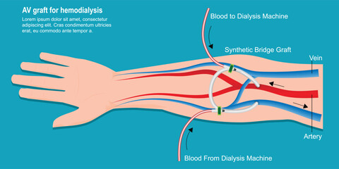 An arteriovenous (AV) graft is a type of access used for hemodialysis.