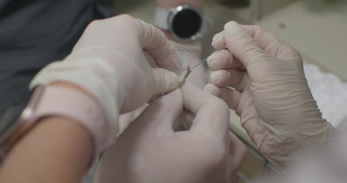 Close-up of a biopsy being placed in a test tube with endoscopic forceps. Taking a biopsy during endoscopy for histological examination. A piece of biopsy is placed in a jar with formalin.