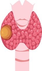 Thyroid disease Illustration 
