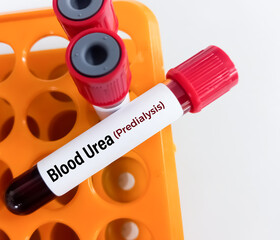 Test Tube with blood sample for predialysis and post dialysis Urea test. Diagnosis of kidney or...