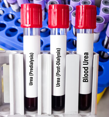 Test Tube with blood sample for predialysis and post dialysis Urea test. Diagnosis of kidney or...