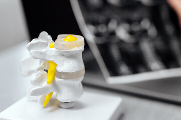 In a contemporary clinic, a physician reviews spine X-rays and anatomical models, noting...