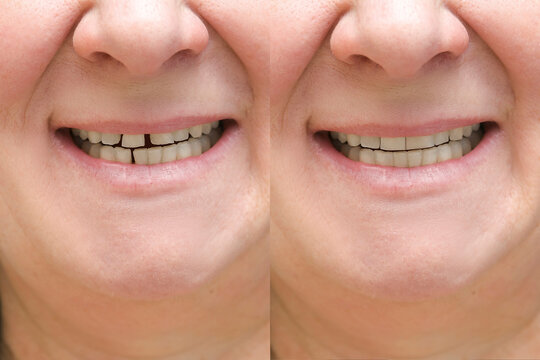 Collage of woman with diastema between upper front teeth before after treatment,showing big gap crack,older middle aged female needs stomatology dentist,medicine healthcare close up.