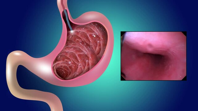 2D animation. Gastric mucosa. Digestive endoscopy or gastroscopy. Performing a gastroscopy procedure. Diagnostics of gastric diseases. Stomach health. Medical concept