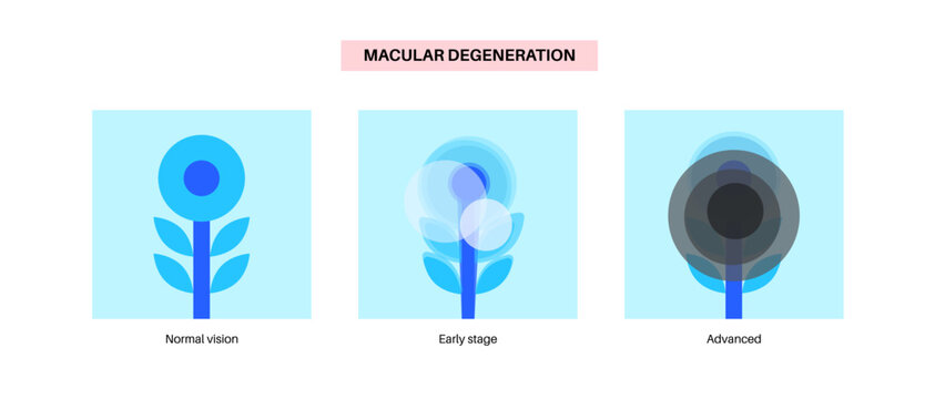 Macular degeneration poster