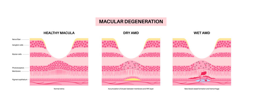Macular degeneration poster