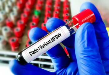 Blood sample for MPox (monkeypox) Clade 1 variant test.