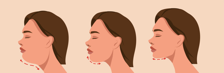  Massage and taping. Woman before and after. A woman with a double chin. SMAS lifting. Expression wrinkles. Vector template for advertising, website, banner, posters, cover