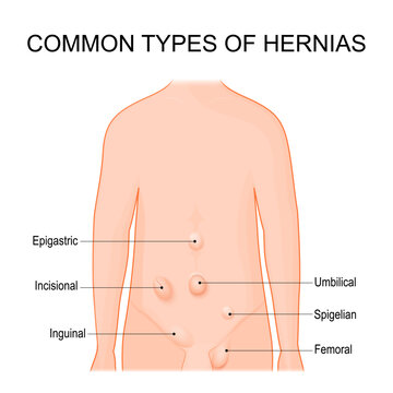Hernia types. Common sites for hernias