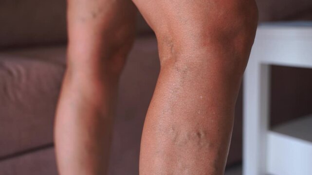  Close-up shot of a mature woman's thigh showing varicose veins, highlighting the natural effects of aging on the skin and vascular health