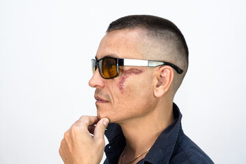 Man hides black eye injury under dark glasses shame drinking and fighting.