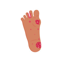 Skin rash, insect bites allergy reaction. irritation on foot logo vector illustration
