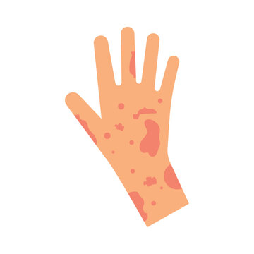 Skin rash, insect bites allergy reaction. irritation on hand logo vector illustration